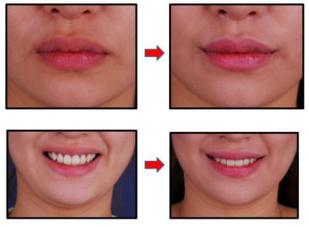 smile plastic surgery